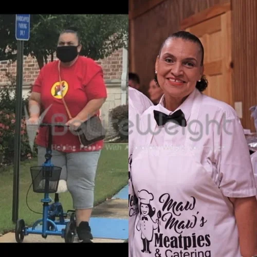 Sleeve to Mini Gastric Bypass Revision Before and After Weight Loss Surgery Before and After